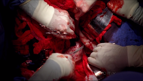 meredith-car-accident-2nd-operation-bleeder-external-iliac-except-its-next-to-liver