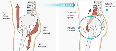 PsoasPosteriorTilt