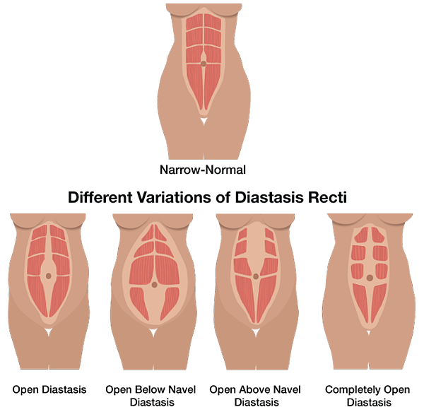 diastasis_recti_illustration3.png