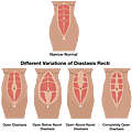 diastasis_recti_illustration3.png