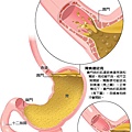 胃食道逆流示意圖