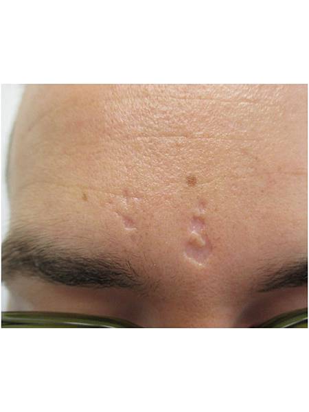 202-herpes-zoster-scars-images