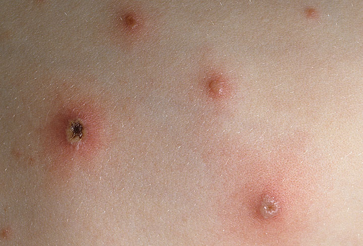 varicella_44