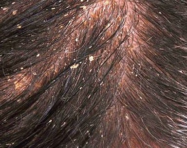 How-to-Prevent-Dandruff-e1365255739989