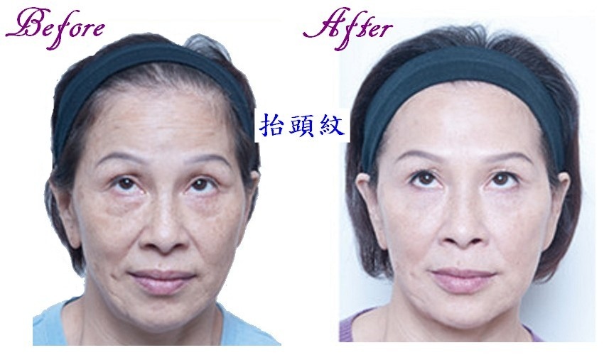 Botox13R.jpg