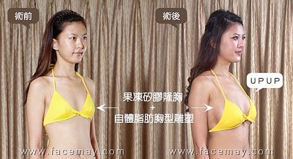 台中隆乳|台中隆乳手術03 台中隆乳|台中隆乳手術03