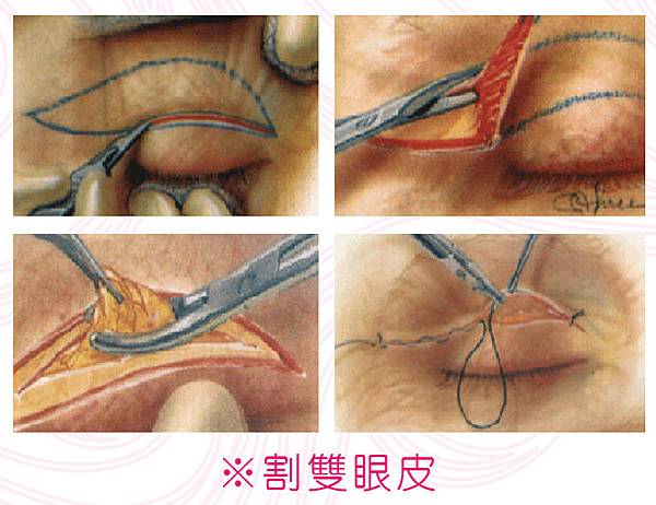 台中割雙眼皮