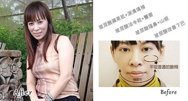 泳霈玻尿酸文案2.jpg 泳霈玻尿酸文案2.jpg