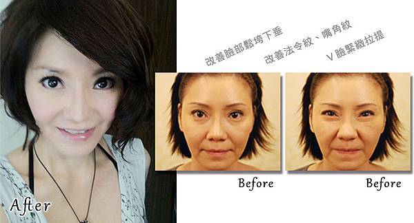 甄莉埋線文案2.jpg 甄莉埋線文案2.jpg