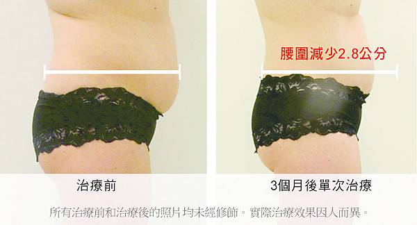 Liposonix文案2.jpg Liposonix文案2.jpg