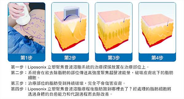 Liposonix文案5.jpg Liposonix文案5.jpg