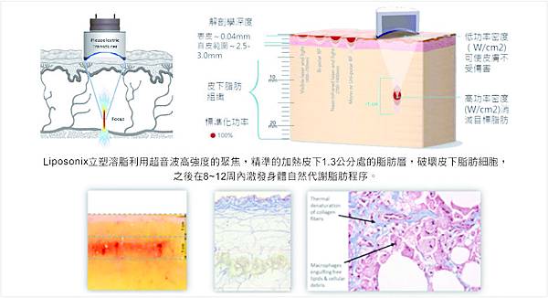 Liposonix文案6.jpg Liposonix文案6.jpg