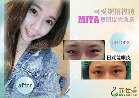 雙眼皮miya2.jpg 雙眼皮miya2.jpg