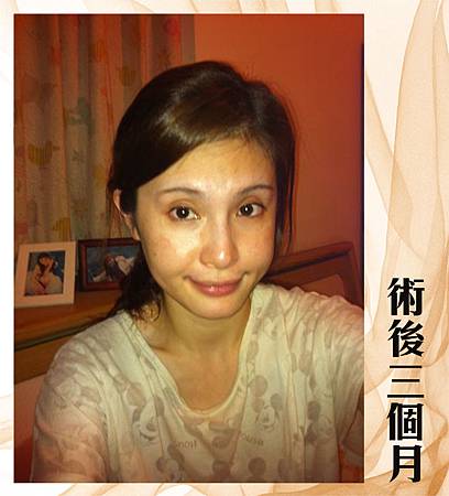 削骨術後三個月.jpg 台中削骨手術、台中削骨整形、台中削顴骨、台中削下頷骨、台中削下顎骨、台中國字臉削骨、台中韓式削骨、台中無痕削骨、台中顏面削骨、台中V臉削骨、台中法拉利削骨、台中削骨價格、台中削骨價錢費用、推薦台中削骨手術醫師醫生、台中削骨權威名醫、台中菲仕美醫學美容整形診所、、林孟羲院長│楊學穎醫師│許永昌醫師│朱純慧醫師