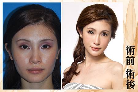 削骨術前術後.jpg 台中削骨手術、台中削骨整形、台中削顴骨、台中削下頷骨、台中削下顎骨、台中國字臉削骨、台中韓式削骨、台中無痕削骨、台中顏面削骨、台中V臉削骨、台中法拉利削骨、台中削骨價格、台中削骨價錢費用、推薦台中削骨手術醫師醫生、台中削骨權威名醫、台中菲仕美醫學美容整形診所、、林孟羲院長│楊學穎醫師│許永昌醫師│朱純慧醫師