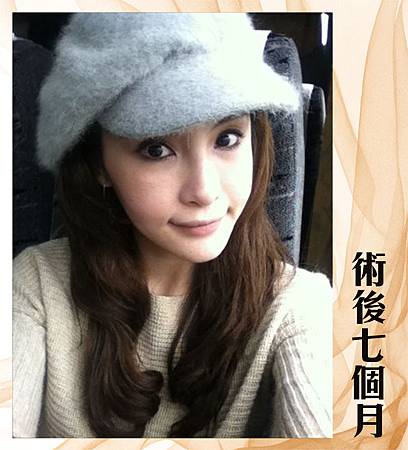 削骨術後七個月.jpg 台中削骨手術、台中削骨整形、台中削顴骨、台中削下頷骨、台中削下顎骨、台中國字臉削骨、台中韓式削骨、台中無痕削骨、台中顏面削骨、台中V臉削骨、台中法拉利削骨、台中削骨價格、台中削骨價錢費用、推薦台中削骨手術醫師醫生、台中削骨權威名醫、台中菲仕美醫學美容整形診所、、林孟羲院長│楊學穎醫師│許永昌醫師│朱純慧醫師
