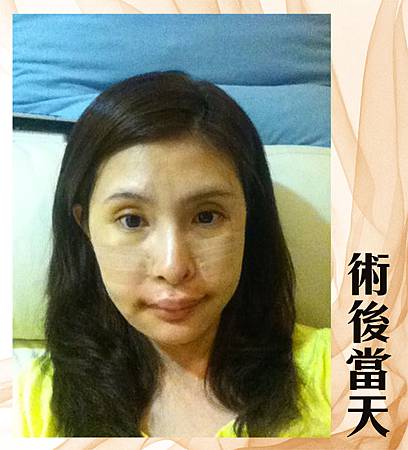 削骨術後當天 台中削骨手術、台中削骨整形、台中削顴骨、台中削下頷骨、台中削下顎骨、台中國字臉削骨、台中韓式削骨、台中無痕削骨、台中顏面削骨、台中V臉削骨、台中法拉利削骨、台中削骨價格、台中削骨價錢費用、推薦台中削骨手術醫師醫生、台中削骨權威名醫、台中菲仕美醫學美容整形診所、、林孟羲院長│楊學穎醫師│許永昌醫師│朱純慧醫師