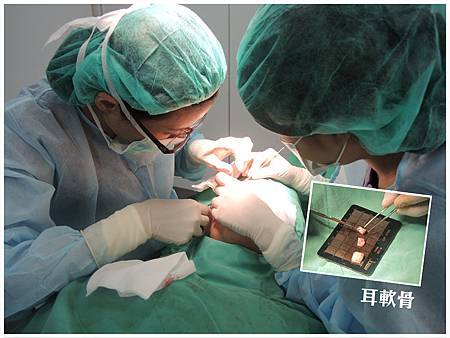 台中二段式隆鼻|台中隆鼻推薦|菲仕美朱純慧 台中二段式隆鼻|台中隆鼻推薦|菲仕美朱純慧