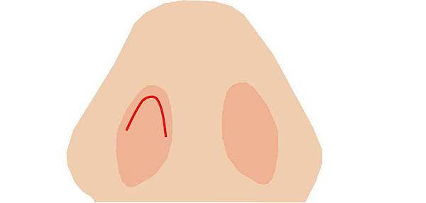 傳統隆鼻切口3