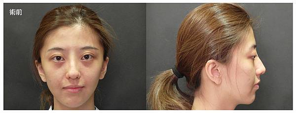 台中自體脂肪豐頰臉部補脂台中菲仕美 台中自體脂肪豐頰臉部補脂台中菲仕美