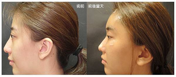 台中自體脂肪豐頰臉部補脂台中菲仕美