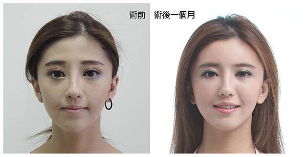 台中自體脂肪豐頰臉部補脂台中菲仕美