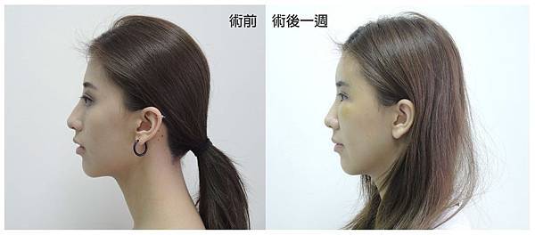 台中自體脂肪豐頰臉部補脂台中菲仕美 台中自體脂肪豐頰臉部補脂台中菲仕美