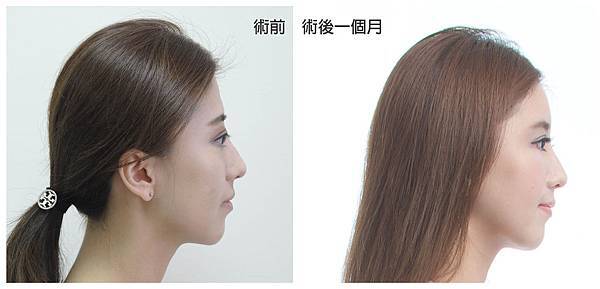 台中自體脂肪豐頰臉部補脂台中菲仕美