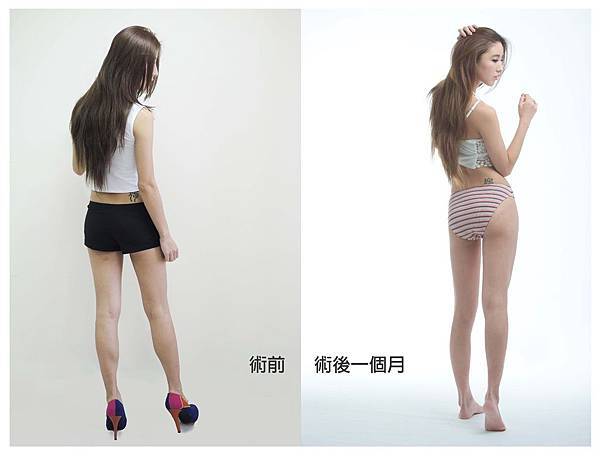 台中自體脂肪豐頰臉部補脂台中菲仕美