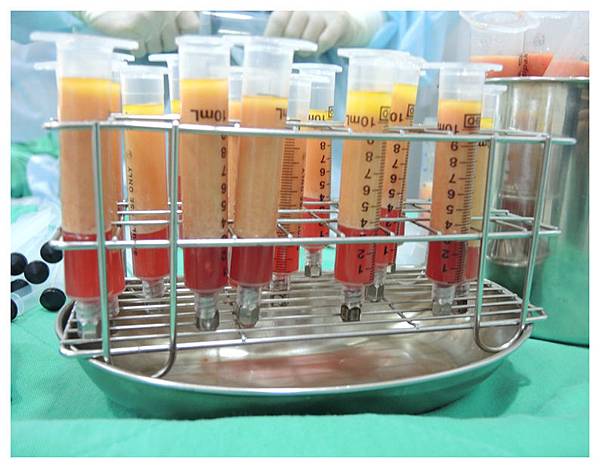 台中抽脂隆乳自體脂肪隆乳菲仕美 台中抽脂隆乳自體脂肪隆乳菲仕美