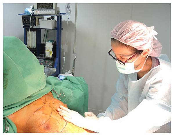 台中抽脂隆乳自體脂肪隆乳菲仕美