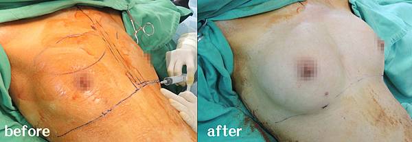 台中抽脂隆乳自體脂肪隆乳菲仕美 台中抽脂隆乳自體脂肪隆乳菲仕美