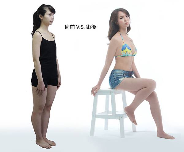 台中抽脂隆乳自體脂肪隆乳菲仕美 台中抽脂隆乳自體脂肪隆乳菲仕美