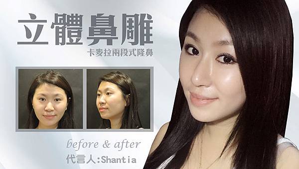 台中隆鼻整形推薦|卡麥拉兩段式隆鼻|菲仕美診所 台中隆鼻整形推薦|卡麥拉兩段式隆鼻|菲仕美診所