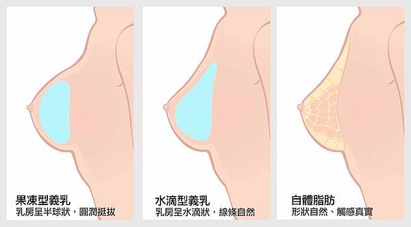 各種隆乳填充示意圖-菲仕美整形外科診所