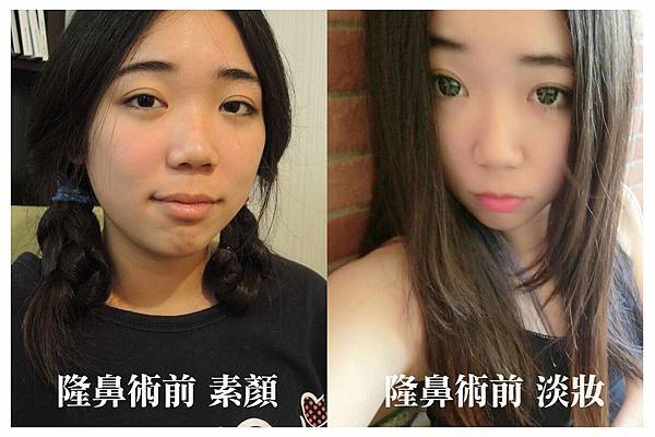 台中韓式隆鼻|三段式隆鼻|台中菲仕美 台中韓式隆鼻|三段式隆鼻|台中菲仕美