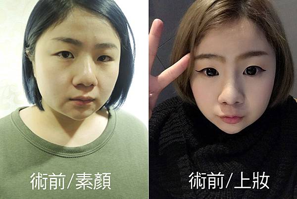 台中雙眼皮推薦|台中縫雙眼皮|菲仕美診所 台中雙眼皮推薦|台中縫雙眼皮|菲仕美診所
