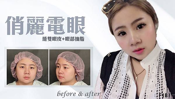 台中雙眼皮推薦|台中縫雙眼皮|菲仕美診所 台中雙眼皮推薦|台中縫雙眼皮|菲仕美診所