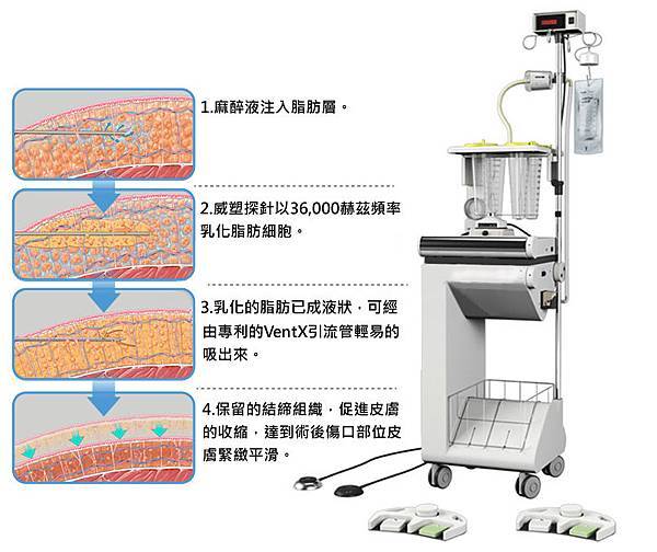 台中抽脂手術威塑抽脂體雕台中菲仕美