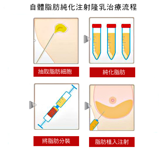 台中自體脂肪隆乳｜抽脂補胸推薦｜台中菲仕美