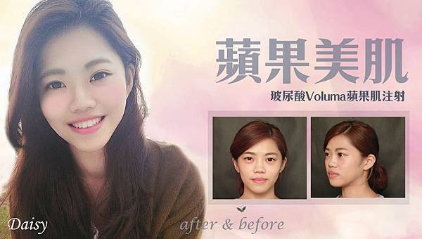 台中玻尿酸醫美|台中玻尿酸微整形|台中菲仕美 台中玻尿酸醫美|台中玻尿酸微整形|台中菲仕美