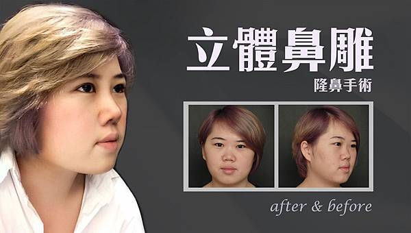 台中隆鼻權威|台中隆鼻|台中菲仕美楊學穎 台中隆鼻權威|台中隆鼻|台中菲仕美楊學穎