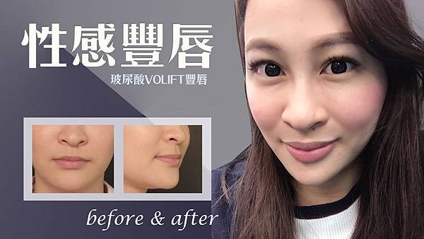 台中玻尿酸豐唇推薦|台中微整形醫美|菲仕美 台中玻尿酸豐唇推薦|台中微整形醫美|菲仕美