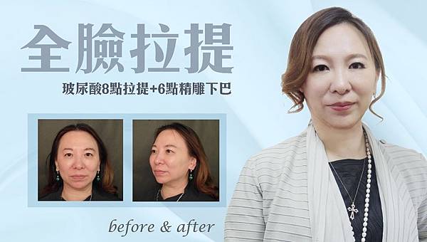 台中玻尿酸拉提|台中玻尿酸微整|菲仕美診所 台中玻尿酸拉提|台中玻尿酸微整|菲仕美診所