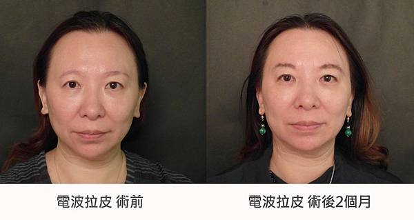 台中玻尿酸拉提|台中玻尿酸微整|菲仕美診所 台中玻尿酸拉提|台中玻尿酸微整|菲仕美診所