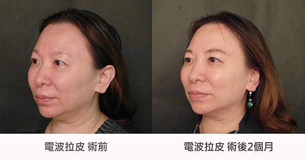 台中玻尿酸拉提|台中玻尿酸微整|菲仕美診所 台中玻尿酸拉提|台中玻尿酸微整|菲仕美診所