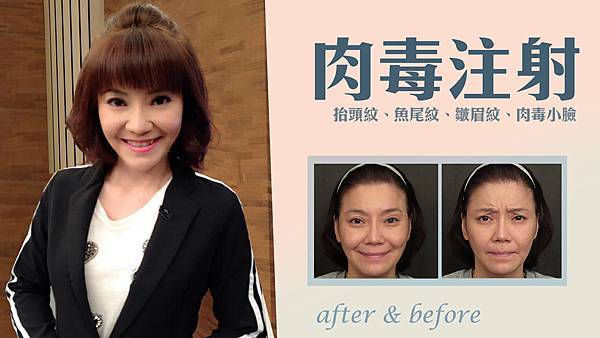 台中肉毒桿菌注射|台中微整形|菲仕美診所 台中肉毒桿菌注射|台中微整形|菲仕美診所
