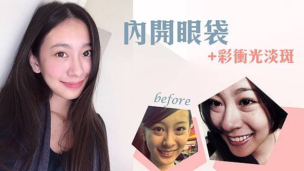 台中眼袋推薦|眼袋內開 |菲仕美診所 台中眼袋、台中眼袋手術、台中消除眼袋、混血精靈系、台中眼袋整形、台中眼袋外開、台中眼袋內開、台中眼袋筋膜整形、台中去眼袋、台中除眼袋、台中割眼袋、台中眼袋下垂、台中眼袋淚溝填補、眼袋浮腫、台中下眼瞼筋膜、眼瞼下垂、開眼頭、大小眼、台中眼袋手術價格、台中眼袋費用價錢、台中眼袋手術醫生醫師、台中眼袋權威、台灣眼部整形專家,林孟羲院長|楊學穎醫師|許永昌醫師|朱純慧醫師