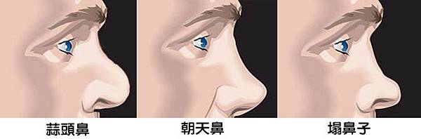 台中三段式隆鼻|台中隆鼻|菲仕美診所 台中三段式隆鼻|台中隆鼻|菲仕美診所