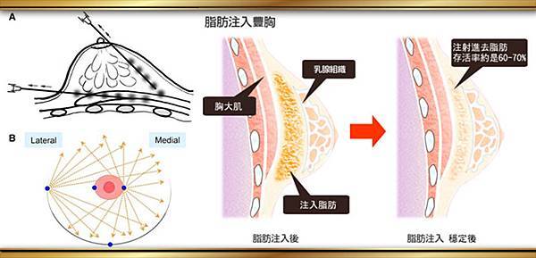 台中隆乳手術方式|隆乳權威推薦｜菲仕美診所